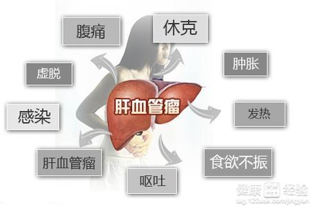 肝血管瘤有哪些症状?怎样治疗好?