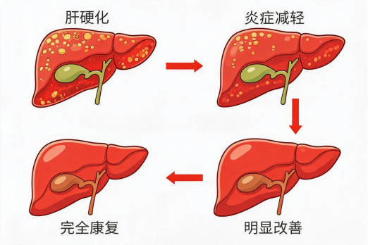 中西医结合逆转肝硬化：孙可主任为您划重点，照着做，真的有机会！