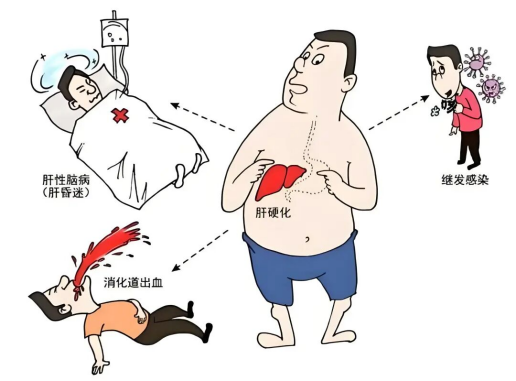酒桌“隐形杀手”酒精性肝硬化！济南中医肝病医院提醒：出现这些信号别硬扛